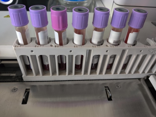 Blood sample tube for medical laboratory test