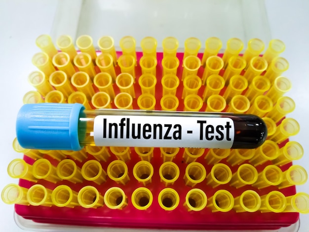 Blood Samples for Influenza A , B virus and  subtype H1N1, H1N2 and H1N3 test at medical laboratory