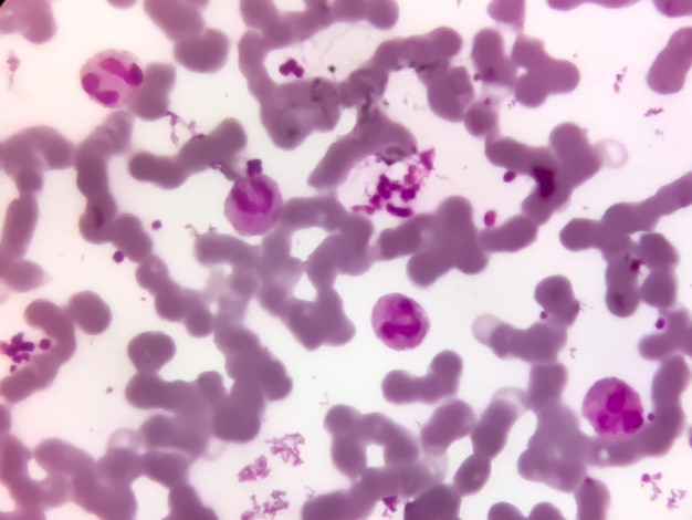 Blood smear microscopic show neutrophilic leucocytosis and thrombocytosis