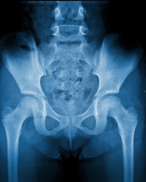 Photo a blue x ray of a hip with the word bone on it