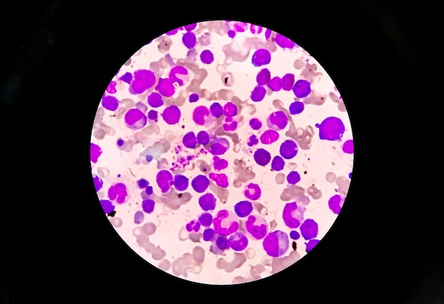 Bone marrow from posterosuperior iliac spine  microscopic 100x zoom showing Myelodysplastic anemia