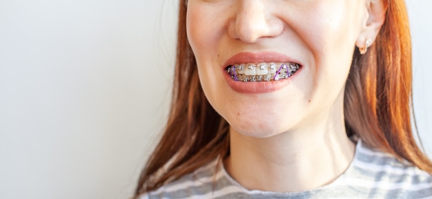 Braces in the smiling mouth of a girl