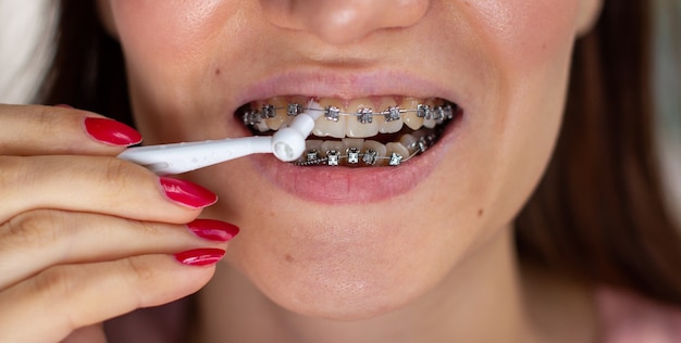 Brasket system in smiling mouth, macro photo teeth, close-up lips, macro shot. Brushing the bracket system