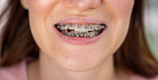 Brasket system in smiling mouth, macro photo teeth, close-up lips, macro shot.