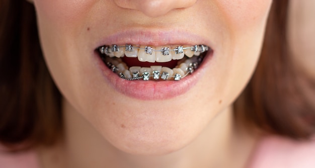 Brasket system in smiling mouth, macro photo teeth, close-up lips, macro shot.