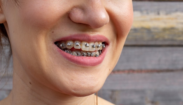 Brasket system in smiling mouth, macro photo teeth, close-up lips, macro shot.