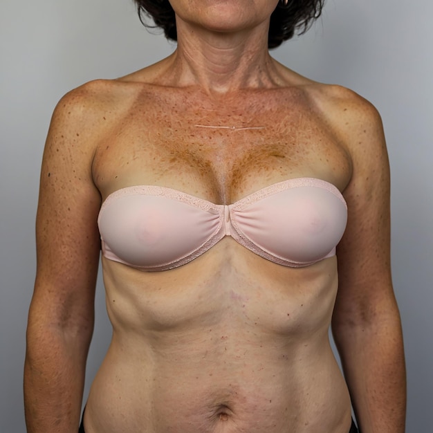 Breast cancer surgery scars by partial mastectomy She can wear a tube top or tube dress and strapless with confident With effect