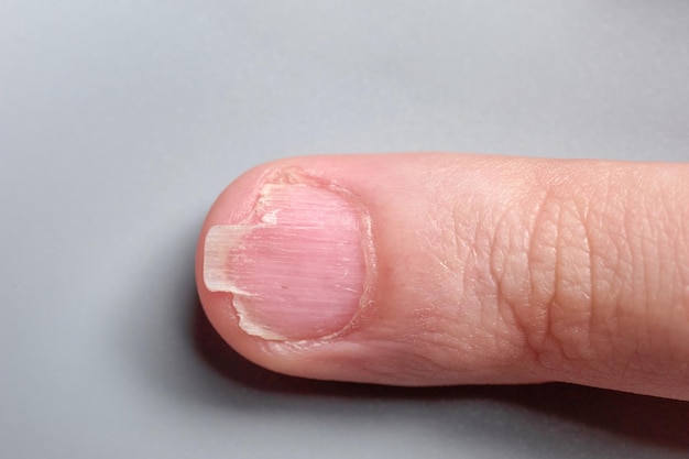 Brittle fingernail of a 9 year old boy close up look isolated on gray background no faces are shown