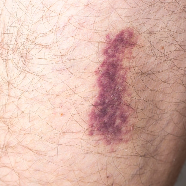 Bruise on leg close up