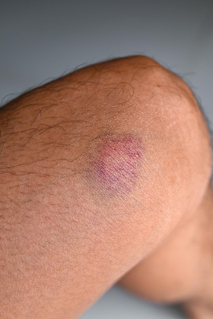 Bruised on knee wound bruised on leg caused by sports and bump or fall leg injury