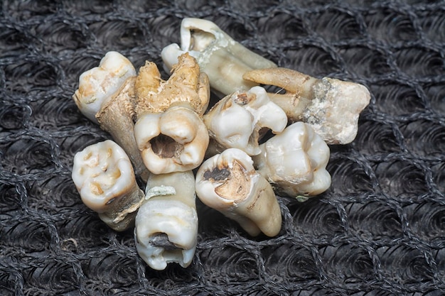 the bundle of unwanted extracted decay human teeth