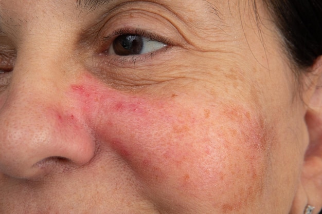 A case of early rosacea on a woman39s face