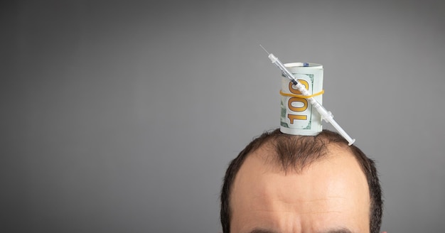 Caucasian man with a syringe and money Money for hair transplantation Hair loss problem