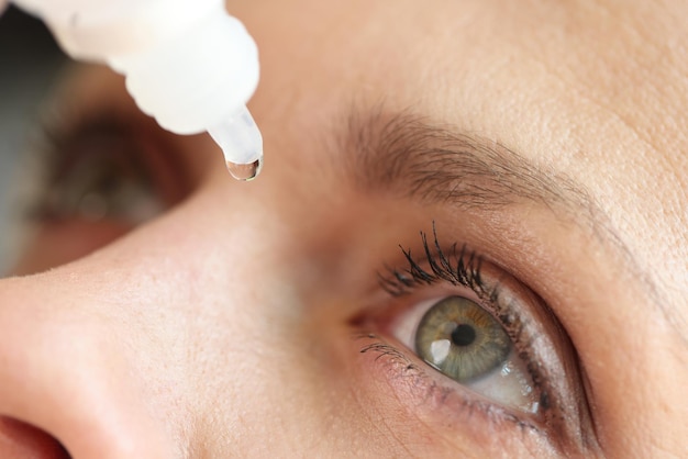 Caucasian woman using medical drops and dripping eye close up dry eyes syndrome eye diseases