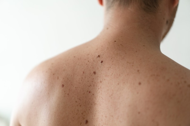 Checking benign moles. Close up detail of the bare skin on a man back with scattered moles and freckles. Pigmentation. Birthmarks on skin