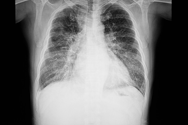 Chest xray film of a patient with cardiomegaly 