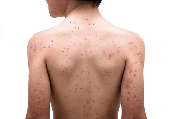 Chickenpox disease boy on his back and sick Chickenpox virus chicken pox outbreak in children Concept of contagion