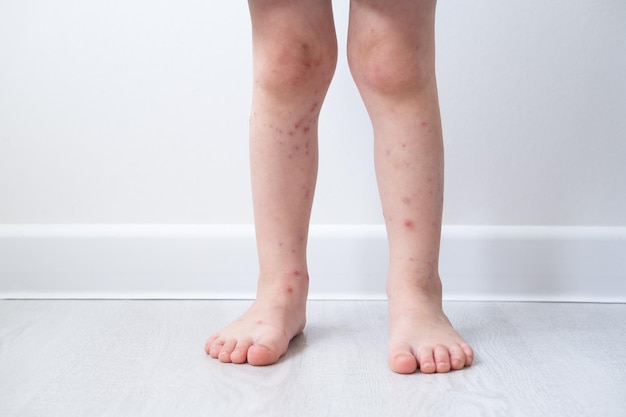 Chickenpox disease, close up  little boy legs with red rashes Chicken pox virus