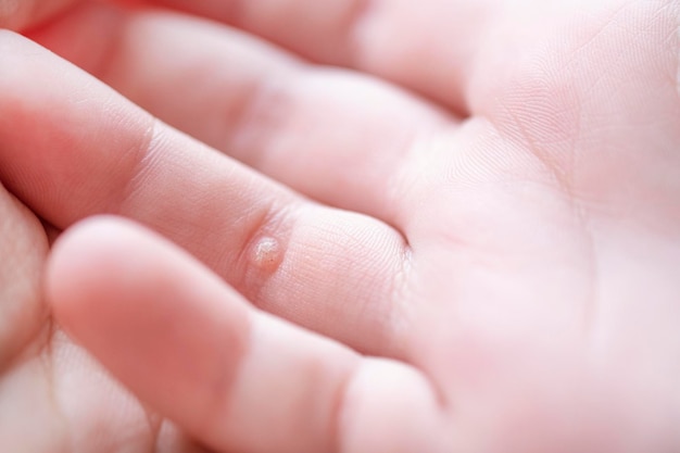 Child hand with warts Pediatric dermatology concept Papillomavirus