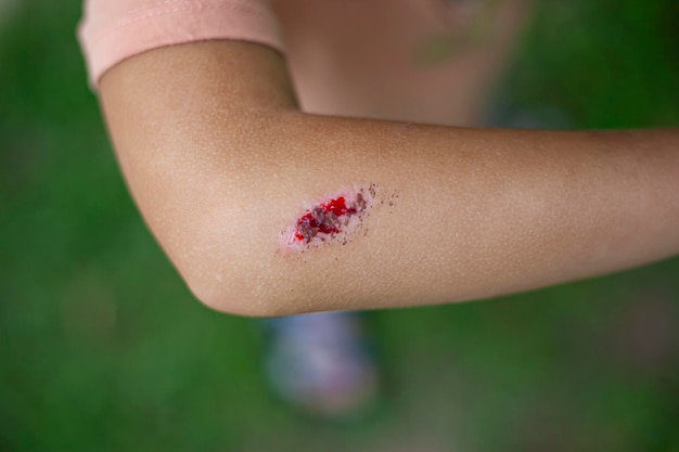 Photo children injury deep scratches on the skin of the childrens elbow hand wounds scratches abrasions on the childs arm