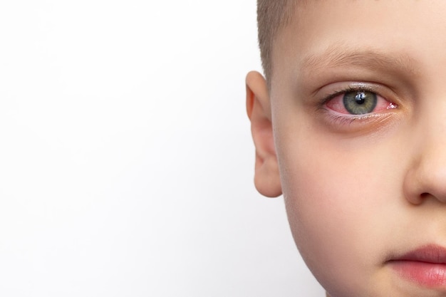 childs face with a red eye isolated on a white background with copy space conjunctivitis allergy