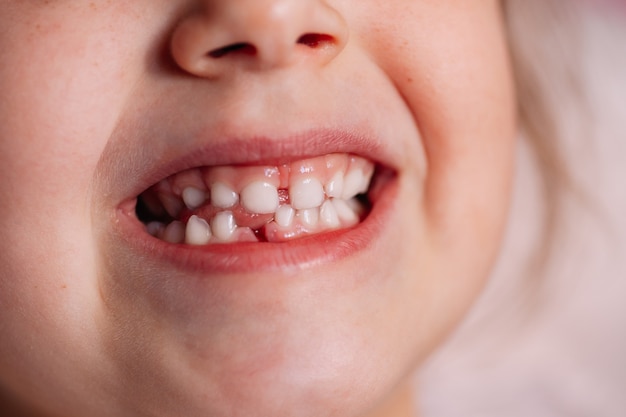 Clenched teeth showing a recent gum wound from a fallen baby tooth