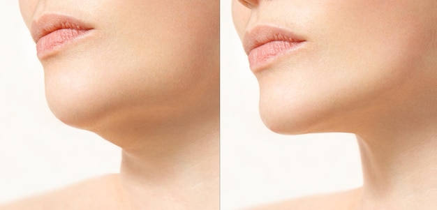 A close portrait of an aged woman before and after facial rejuvenation procedure Correction of the chin shape liposuction of the neck The result of the procedure in the clinic of aesthetic medicine