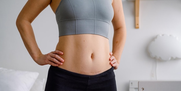 Close up of a belly with scar from csection Women's health A woman dressed up in sportswear demonstrating her imperfect body after a childbirth with nursery on the background