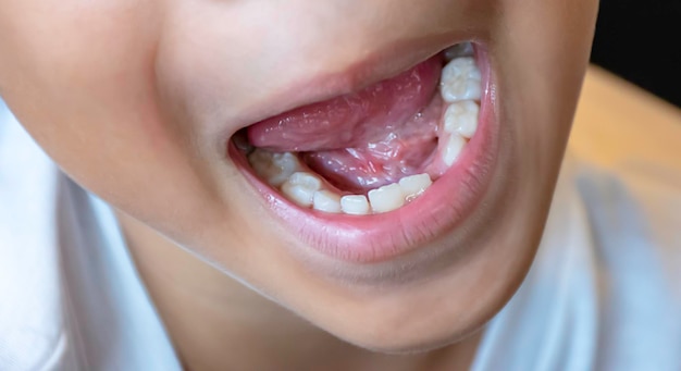 Close-up of boy with missing tooth