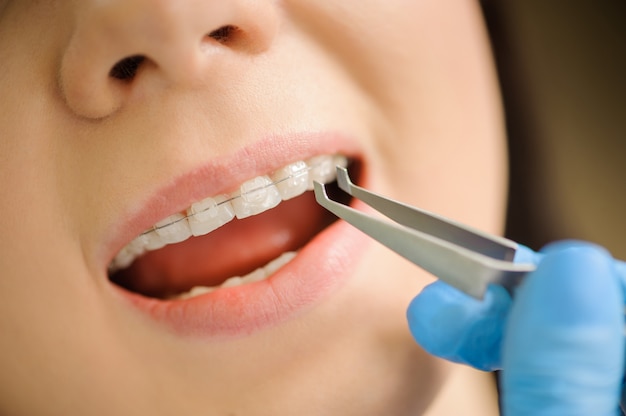 Close-up ceramic brackets at the dental clinic