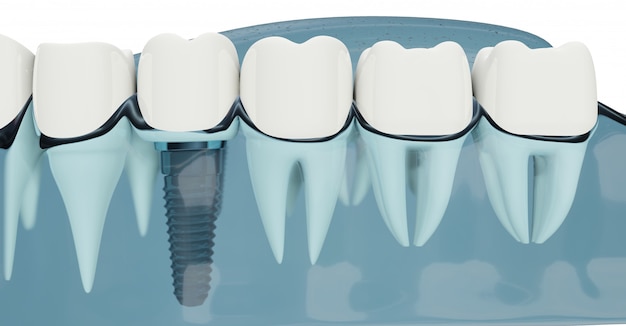 Close up Component of Dental implants. Blue color transparent. 3d illustrations