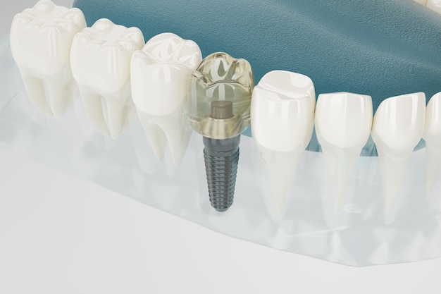 Close up Component of Dental implants transparent. 3D rendering.