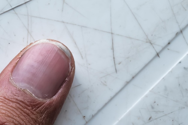 close up detail of dry skin and spli nail