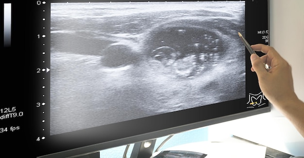 Close up Doctor point Ultrasound diagnostics of the thyroid gland on morintor reportMedical healthcare concept