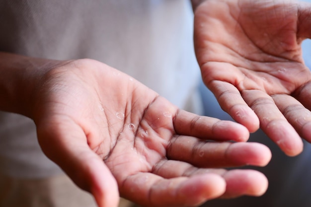 Close up of Dry cracked skin of a men39s hand