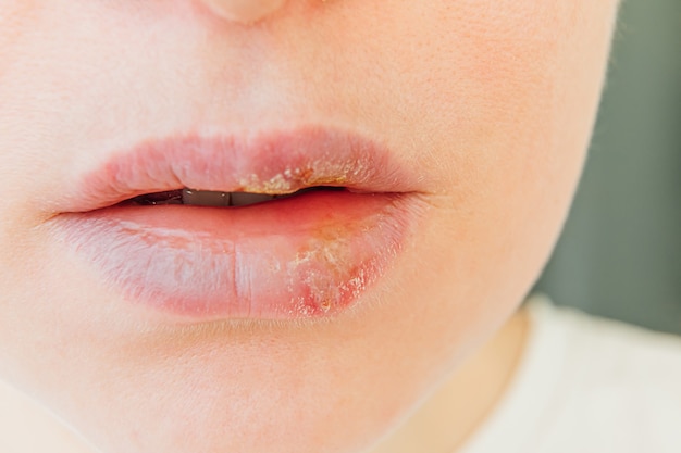 Close up of girl lips affected by herpes. Treatment of herpes infection and virus.