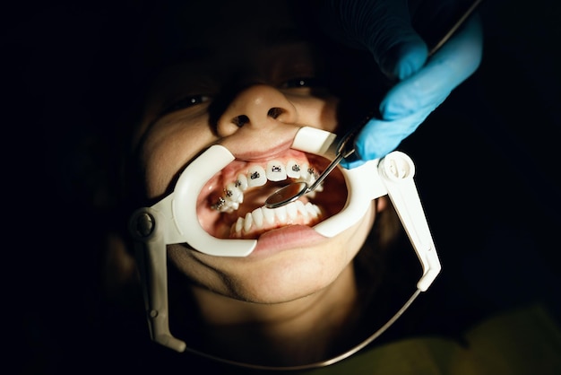 Close up of girl with brackets receiving dental braces treatment in clinic