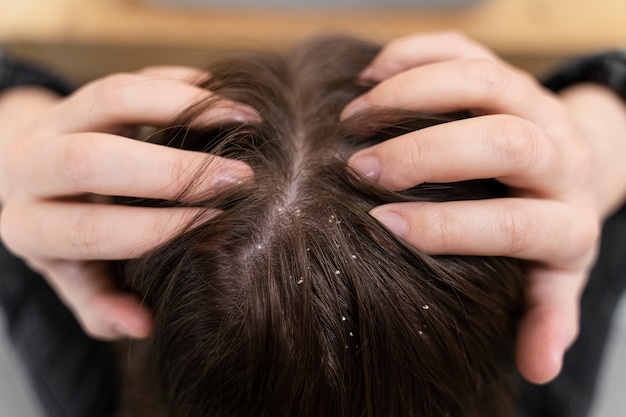 Close up on hair with dandruff