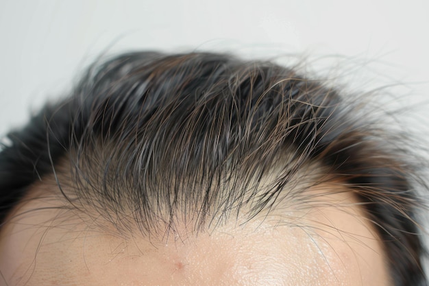 Close up Man with little hair due to alopecia or hair loss Isolated on white background