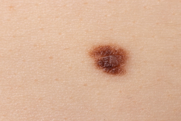 Close-up mole on human skin.