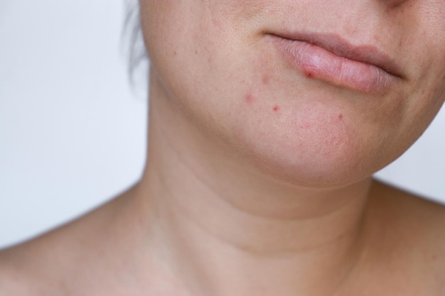 close up natural woman bad acne skin with scars