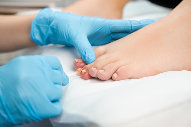 Photo close up podologist treats the nail with an antifungal agent