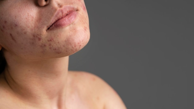 Close-up portrait of young woman with acne