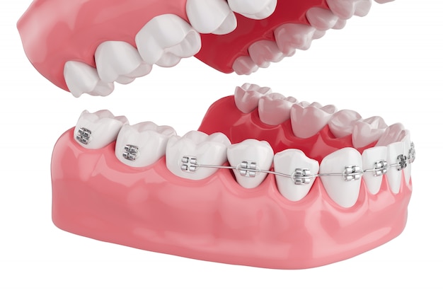 Close up Process Health Teeth with Brace. Selective focus. 3D Render.