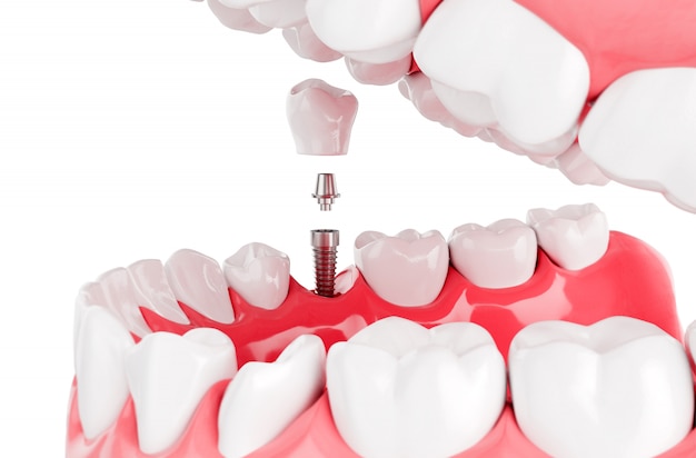 Close up Process Implants teeth health care. Selective focus. 3D Render.