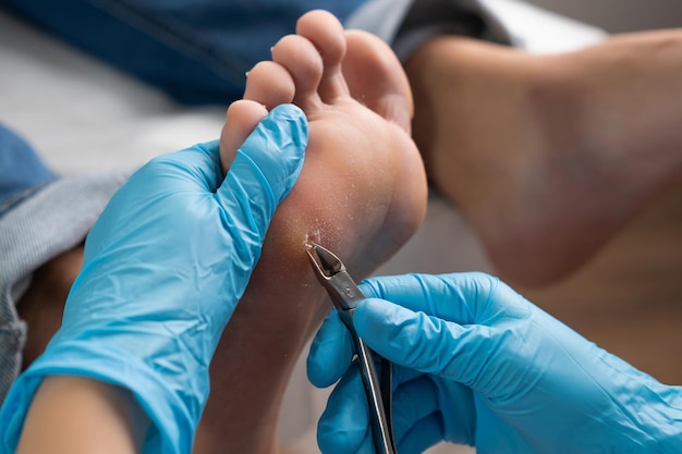 Photo close up removing a callus on a womans foot by nippers