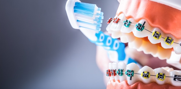 Close-up teeth braces and tooth brush as an example of toothbrushing.