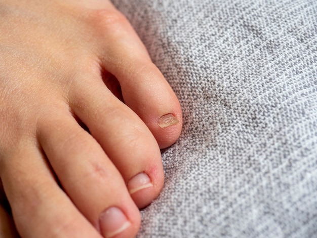 Close up of a woman's foot with problems on the nails lying on a gray blanket