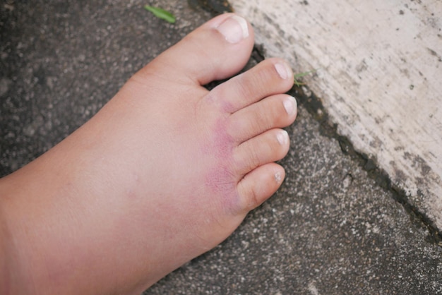 Close up of women feet with swelling