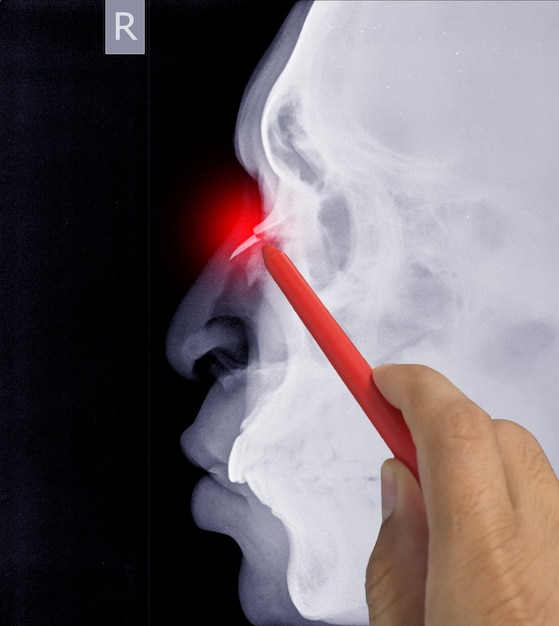 Close up X-ray Nasal bone Lateral showing fracture nasal bone, Doctor holding a red pen point , symptoms medical healthcare concept.